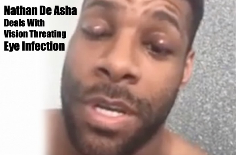 Nathan De Asha eye infection